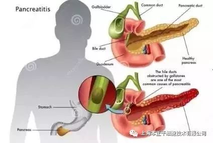 胰腺炎新篇章：前沿研究为健康保驾护航